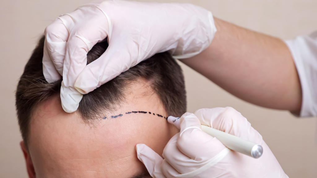 Finding the Best Hair Transplant in Brisbane: What to Look For